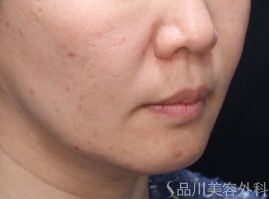 症例NO.73333のBEFORE写真