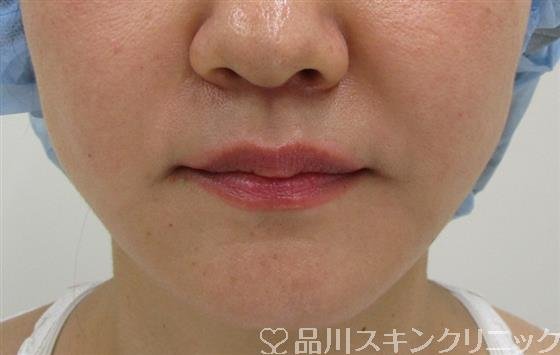 症例NO.35438のAFTER写真