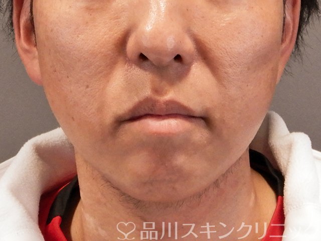 症例NO.70490のBEFORE写真