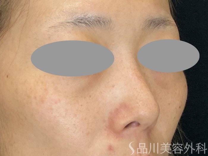 症例NO.73020のBEFORE写真