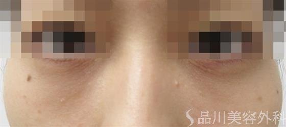 症例NO.45560のAFTER写真