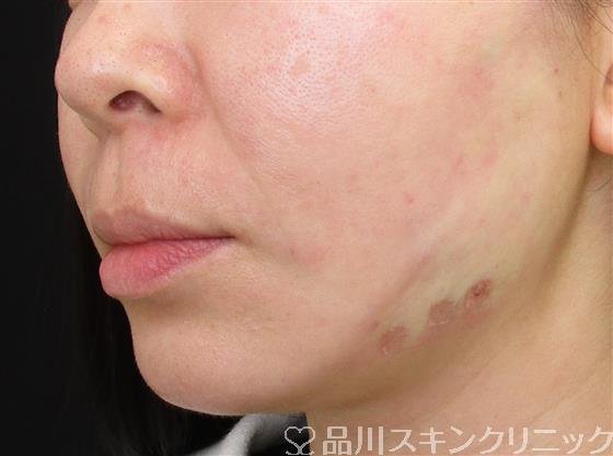 症例NO.57920のAFTER写真