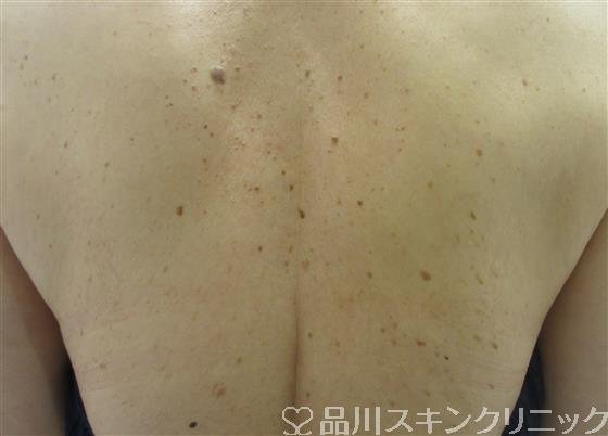 症例NO.32811のBEFORE写真
