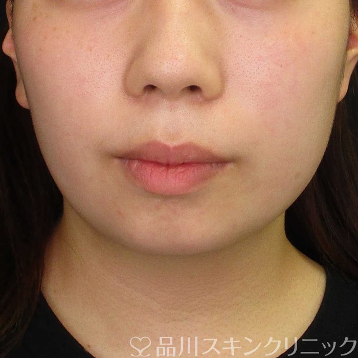 症例NO.67771のBEFORE写真