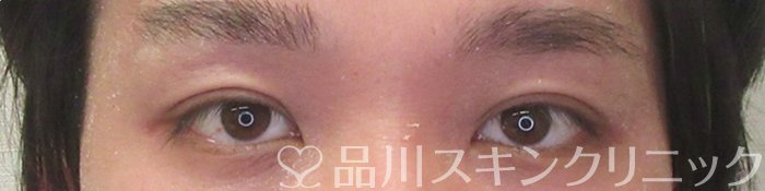 症例NO.74413のAFTER写真