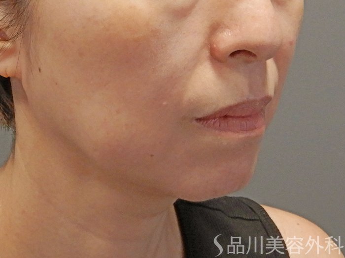 症例NO.72002のBEFORE写真