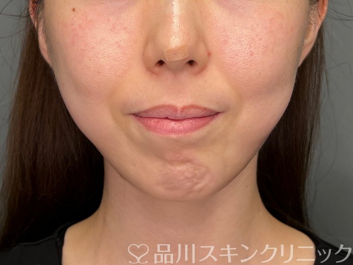症例NO.64894のAFTER写真