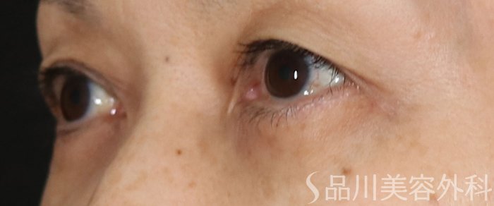 症例NO.74233のBEFORE写真