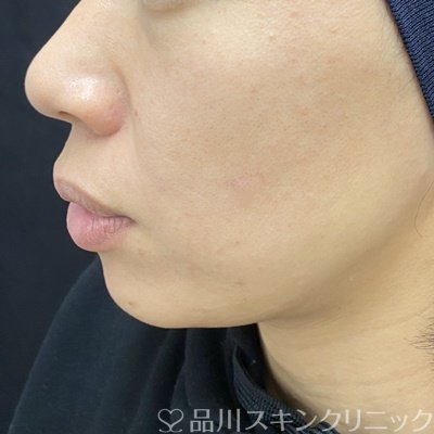 症例NO.64172のBEFORE写真