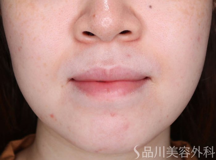 症例NO.72310のAFTER写真