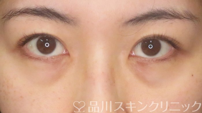 症例NO.64358のBEFORE写真