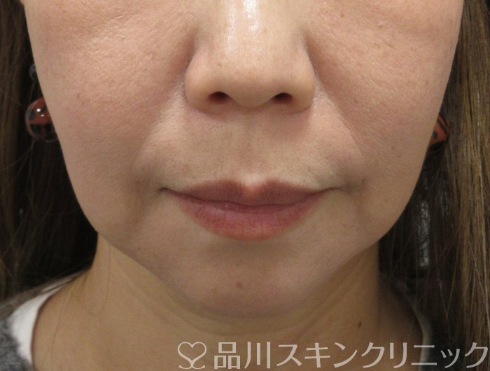 症例NO.74838のBEFORE写真