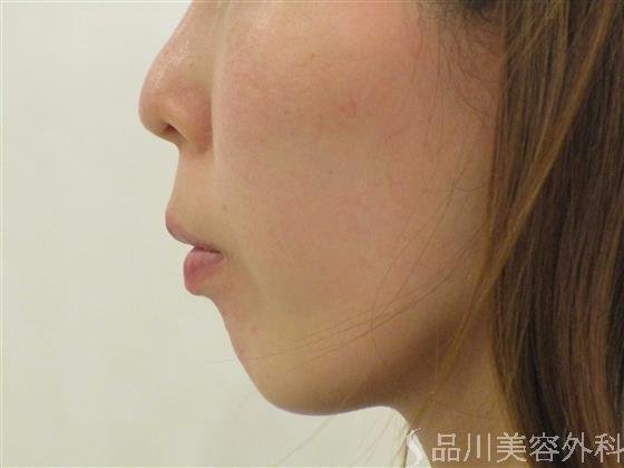 症例NO.54796のBEFORE写真