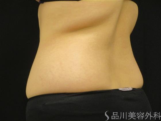 症例NO.53422のBEFORE写真