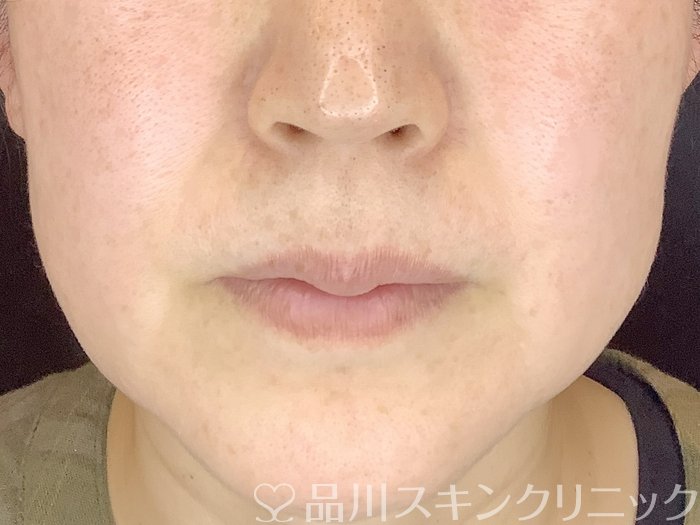 症例NO.65174のBEFORE写真
