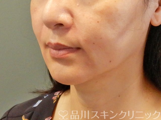 症例NO.66748のAFTER写真