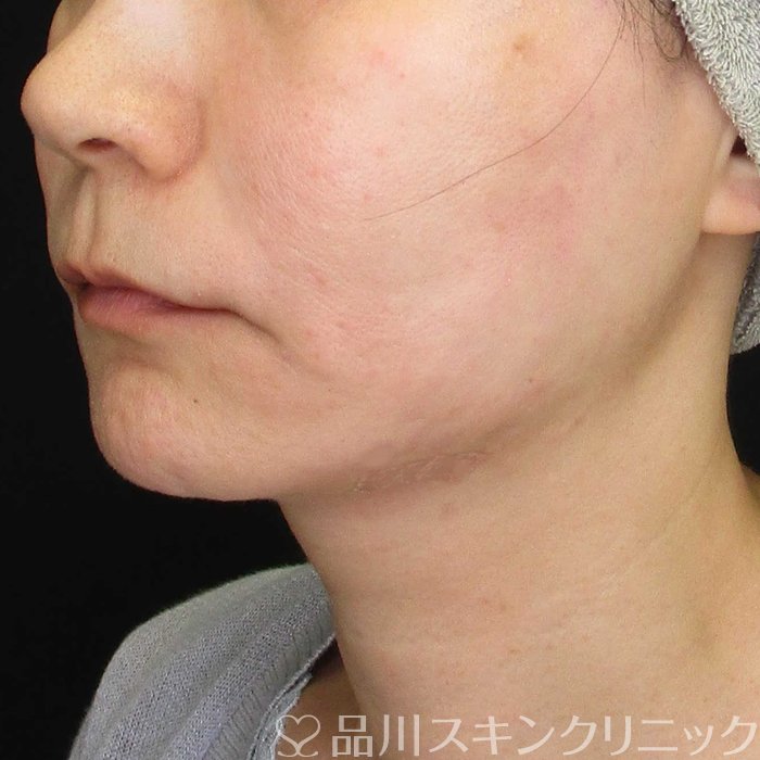 症例NO.70165のAFTER写真