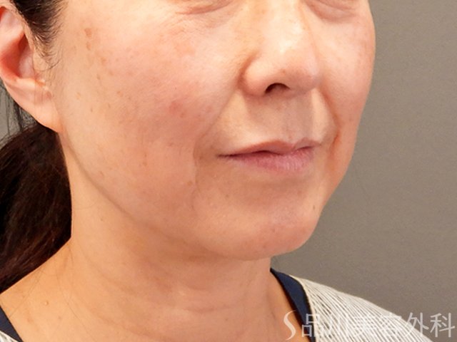 症例NO.70433のBEFORE写真