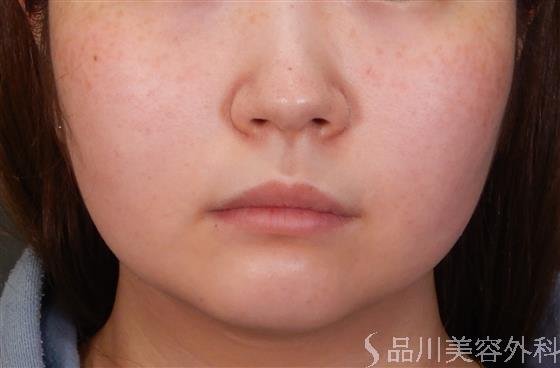 症例NO.56512のBEFORE写真