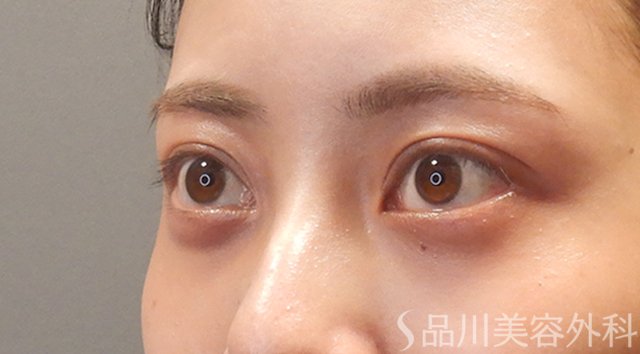症例NO.74746のAFTER写真