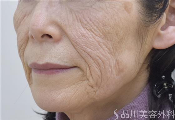 症例NO.50857のBEFORE写真