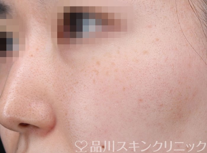 症例NO.73495のBEFORE写真