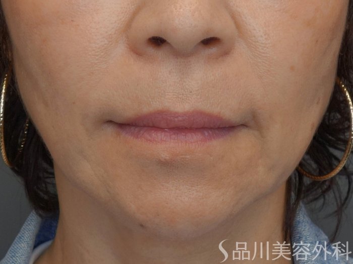 症例NO.74447のBEFORE写真
