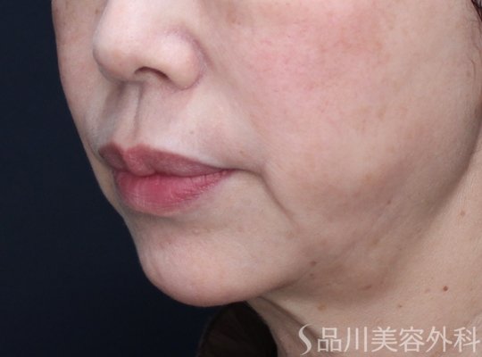 症例NO.72376のBEFORE写真