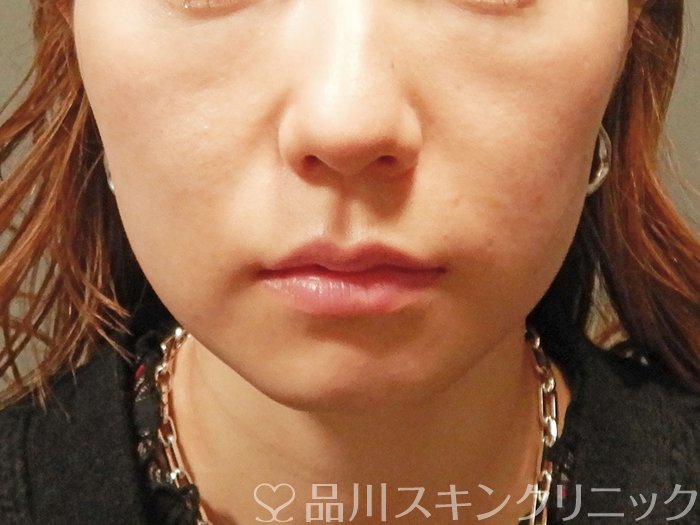 症例NO.62409のBEFORE写真