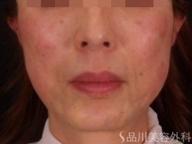 症例NO.73531のAFTER写真