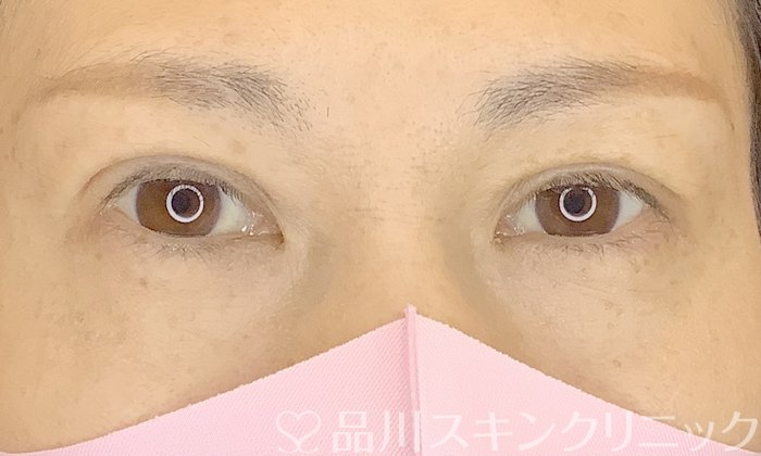 症例NO.65384のAFTER写真
