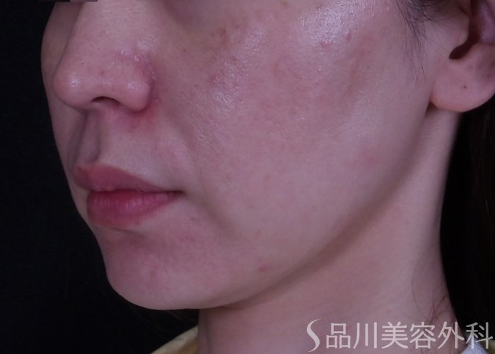 症例NO.70210のBEFORE写真