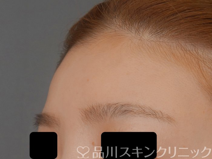 症例NO.72318のBEFORE写真