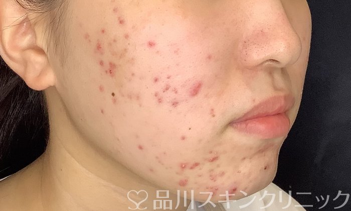 症例NO.74184のBEFORE写真