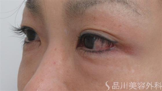 症例NO.26547のBEFORE写真