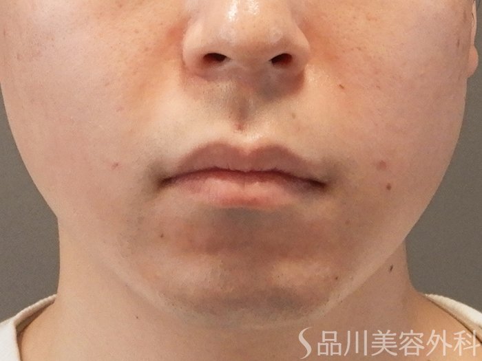 症例NO.69731のAFTER写真