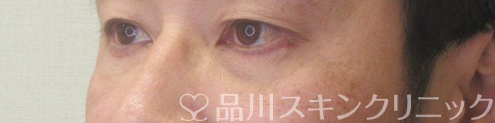 症例NO.73726のAFTER写真