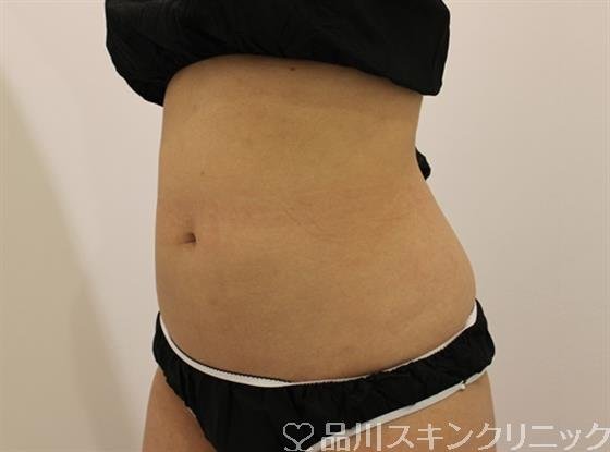 症例NO.45954のAFTER写真