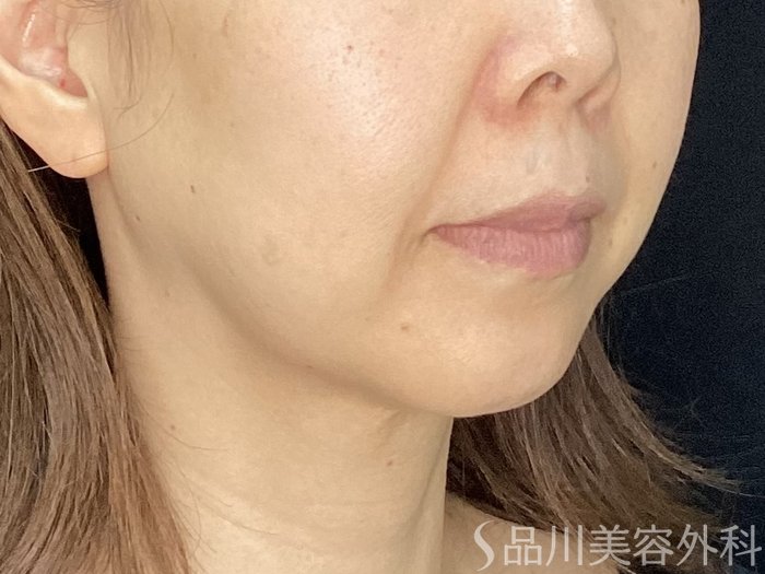 症例NO.71785のBEFORE写真