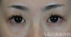 症例NO.75146のBEFORE写真