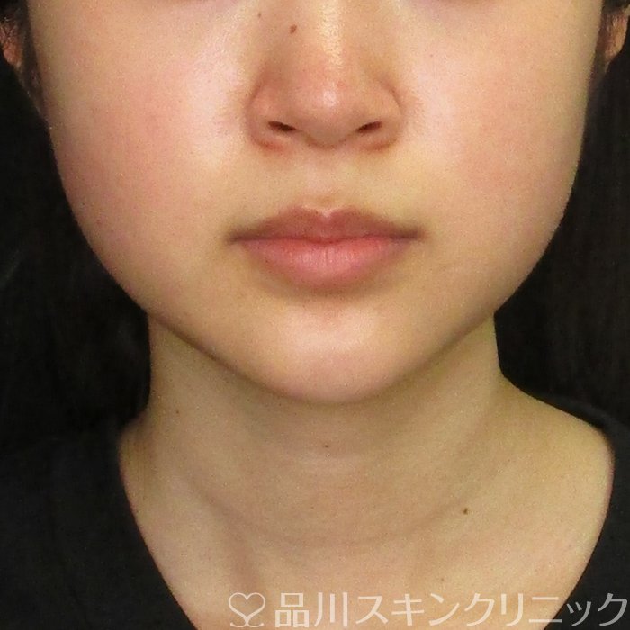 症例NO.70333のBEFORE写真