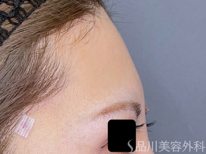 症例NO.74780のBEFORE写真