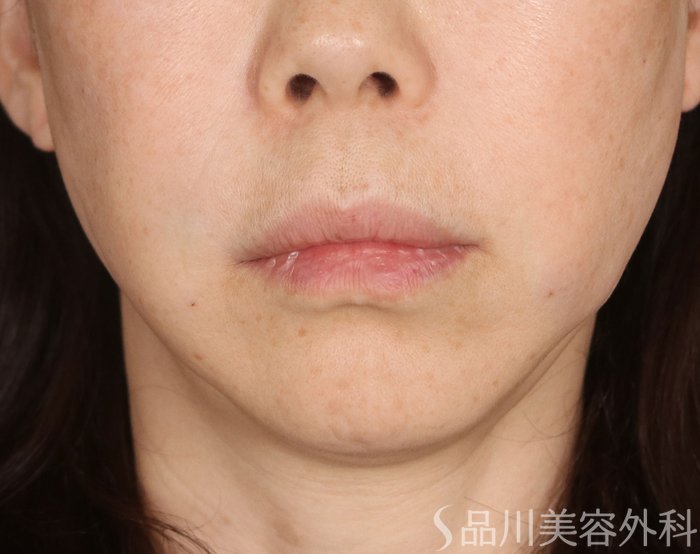 症例NO.73716のAFTER写真