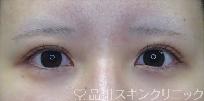 症例NO.69408のAFTER写真
