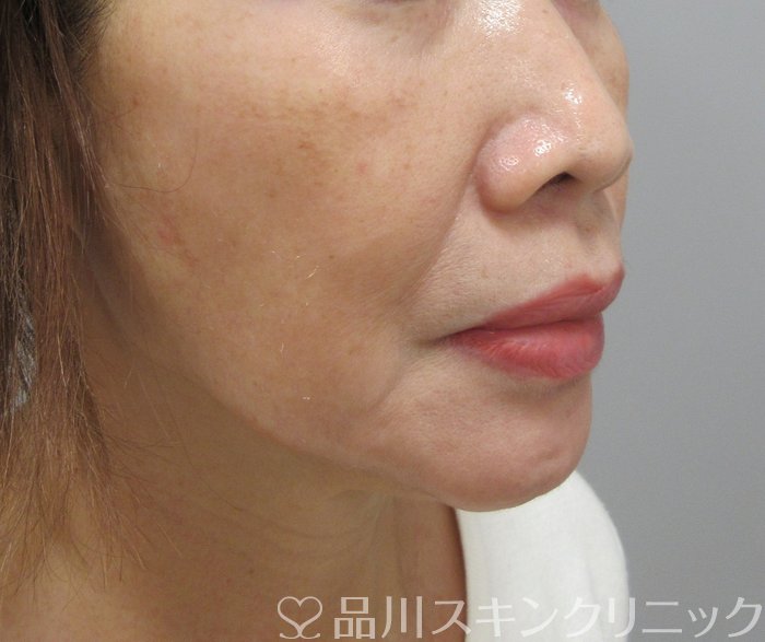症例NO.74459のBEFORE写真