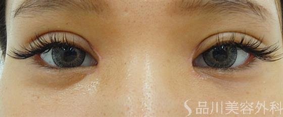 症例NO.36175のAFTER写真