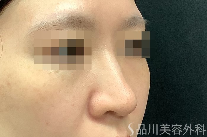 症例NO.71249のBEFORE写真