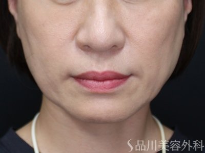 症例NO.75247のAFTER写真