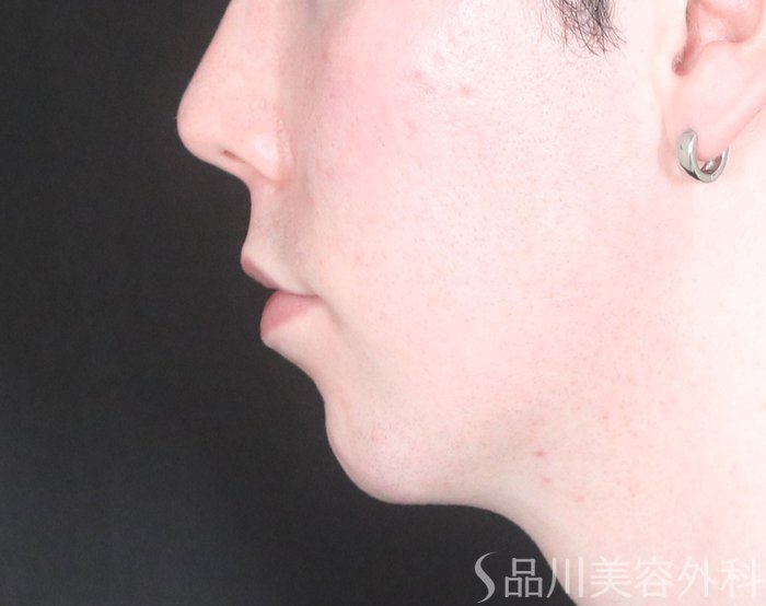 症例NO.72905のBEFORE写真