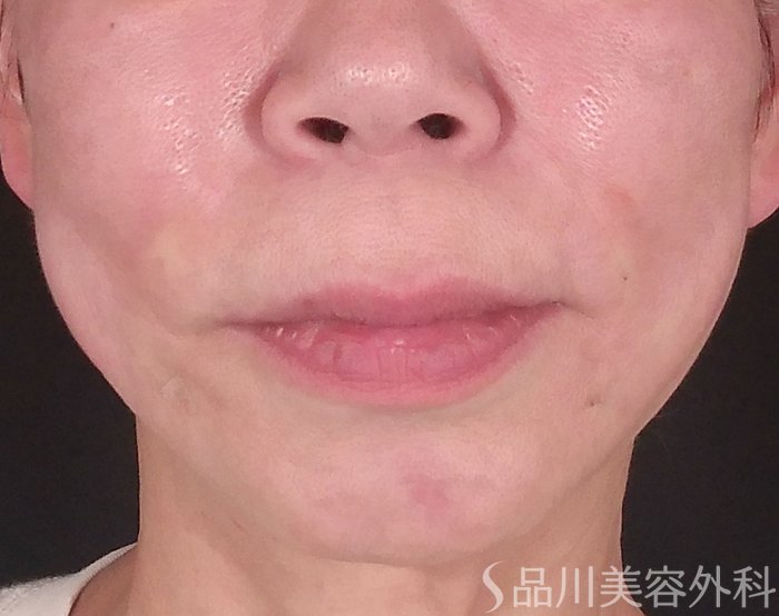 症例NO.70354のAFTER写真